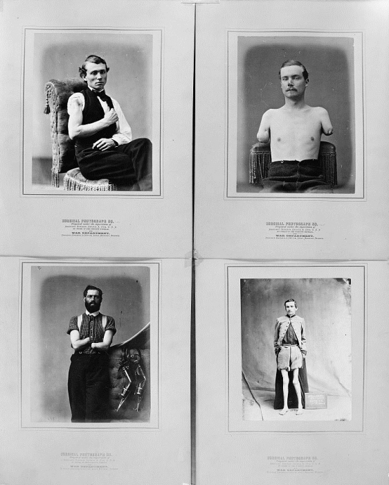 This series of photographs, compiled by the U.S. Surgeon General's Office, illustrates the different types of arm amputations. During the Civil War, surgeons performed two types of amputation: circular and flap. A circular amputation involved rolling the tissue and skin up like a cuffed sleeve before cutting the bone. Afterward, the doctor would roll the “cuff” back down, sew it together, and create a stump. A flap amputation entailed creating two long flaps of skin and tissue that were folded and sewn over the cut bone. The soldiers depicted above are Private John Brink of the 11th Pennsylvania Cavalry (top left), Sergeant Warden (top right), Private Samuel H. Decker of the 9th U.S. Artillery (lower left), and Drummer Allison Shutte of the 7th Pennsylvania Reserves (lower right).