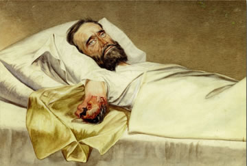 This drawing of Union soldier Milton E. Wallen highlights the dangers of amputation surgery. After having his arm removed by Confederate doctors, Wallen headed toward Union lines for medical attention. While recuperating at the Navy School Hospital in Annapolis, Wallen’s stump became infected with gangrene. “Hospital gangrene” was a chronic problem during the war. A small black spot would appear in the wound and slowly expand, resulting in loosened skin, necrosis of body tissue, and corresponding putrid smells. The likelihood of gangrene increased the longer an amputation surgery was delayed—thereby increasing the likelihood of death post-surgery. However, by 1864, Union surgeons learned to control gangrene by pouring carbolic acid—a painful but effective antiseptic—over the infection. 